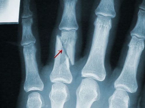 Перелом пальца ноги