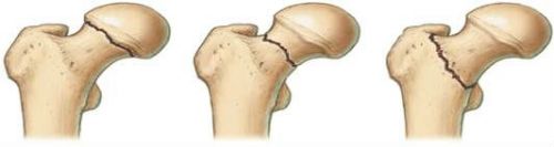 Перелом шейки бедра