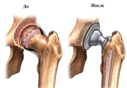 Протезирование сустава