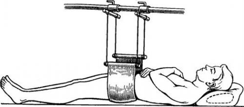 Гамак при переломе костей таза