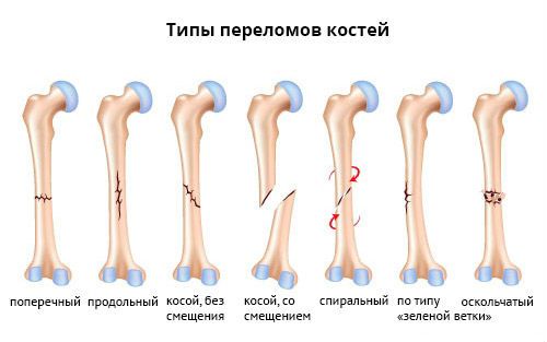 Типы переломов костей