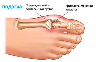 Отложение солей при подагре