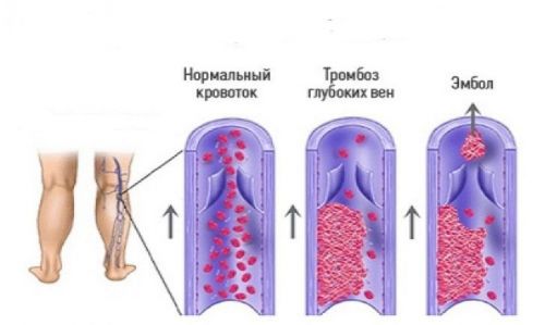 Тромбоз вен