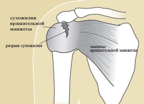 Разрыв сухожилия вращательной манжеты