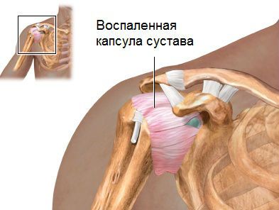 Воспаление капсулы плечевого сустава