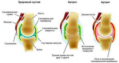 Артроз и артрит сустава