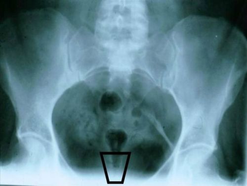 Рентгенография костей таза