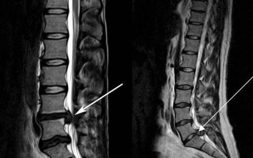 Позвоночная грыжа на снимке