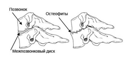 Остеофит