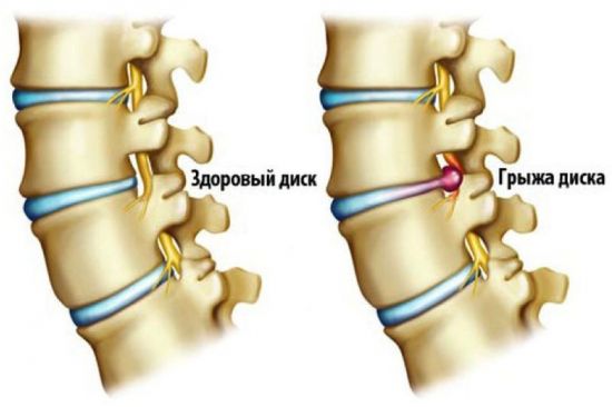 Грыжа позвоночника