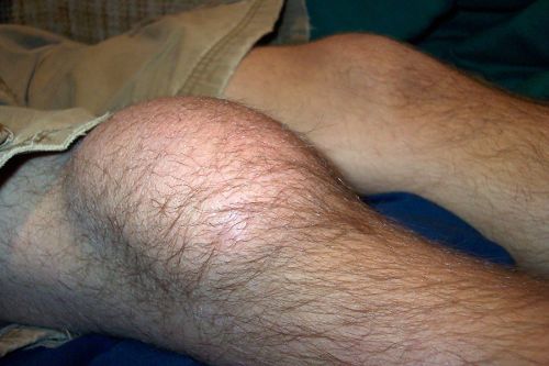 Воспаленное колено