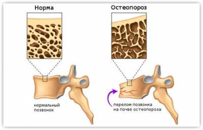 Позвонки при остеопорозе