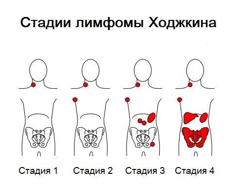 Стадии лимфомы Ходжкина