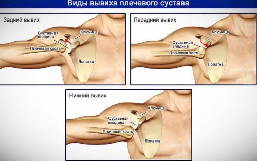 Виды вывиха плеча