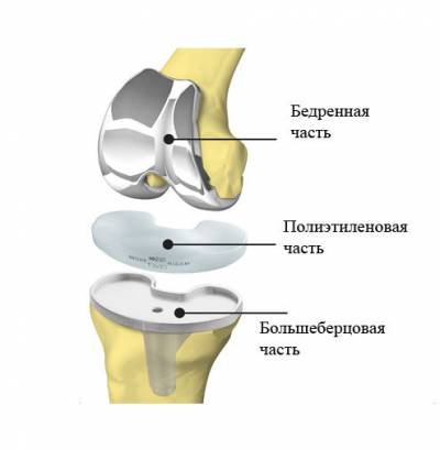Тотальный эндопротез коленного сустава