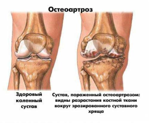 Деформирующий остеоартроз колен