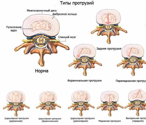 Типы протрузий межпозвоночных дисков