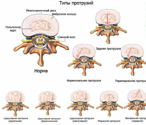 Виды протрузий межпозвоночных дисков