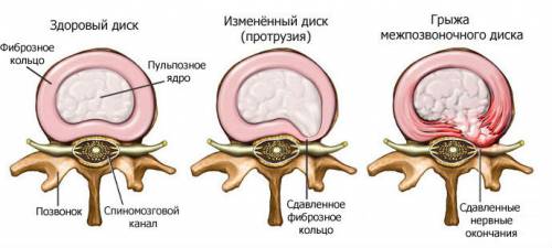 Этапы развития остеохондроза