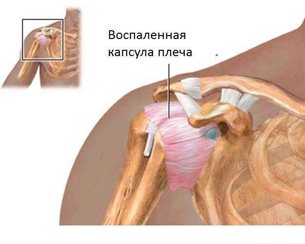 Воспаленная капсула плеча