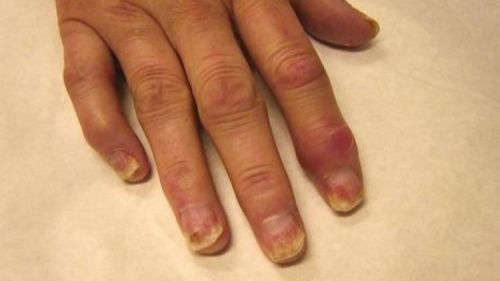 Пальцы, пораженные артритом