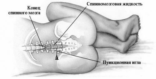 Прокол для пункции