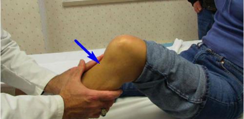 разрыв связок коленного сустава