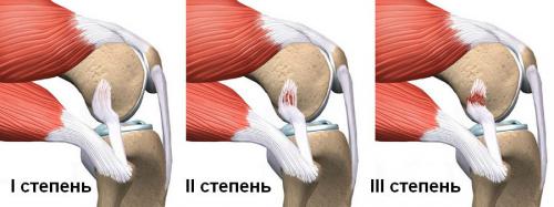 Степени разрыва связок колена