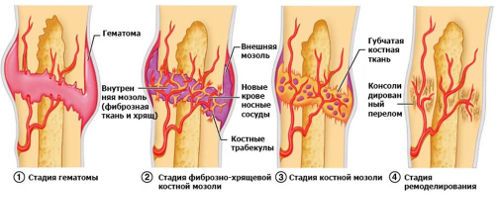 Регенерация при переломе кости