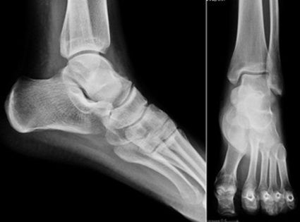 Рентген-снимок ноги