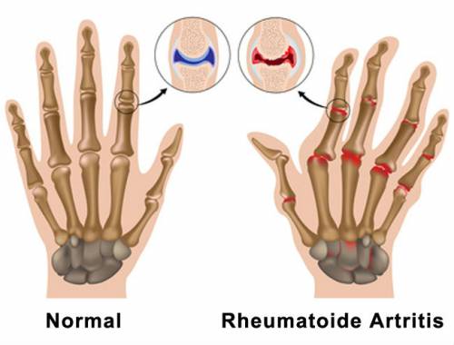 Суставы в норме и при ревматоидном артрите