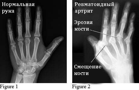 Рентген суставов кистей рук