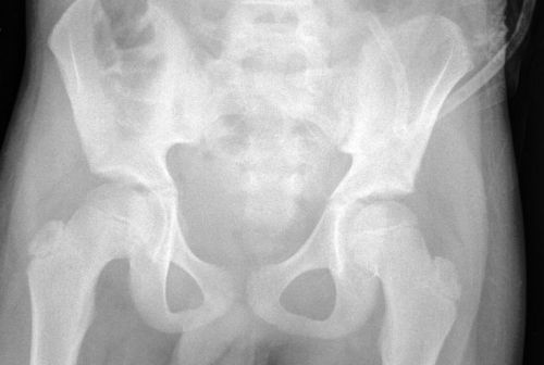 Рентген тазовых костей