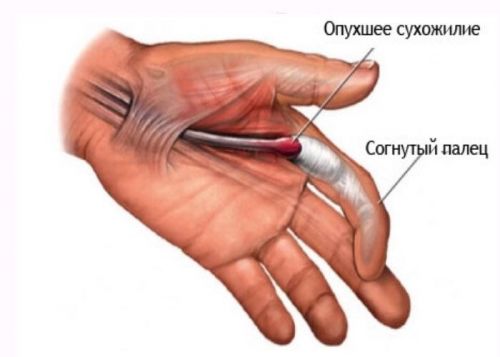 Воспаление сухожилия