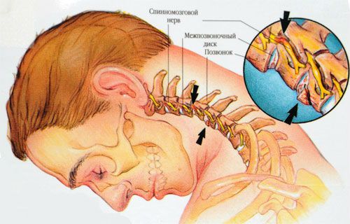 шейный хондроз