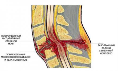 Осложненный перелом позвоночника
