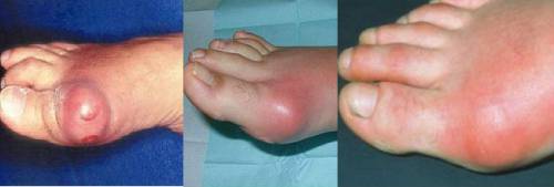 Подагрический артрит первого пальца стопы