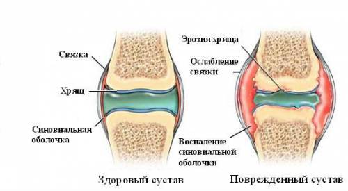 Изменения в суставе при синовите