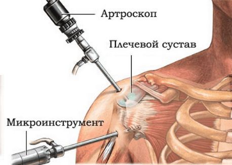 Артроскопия плеча