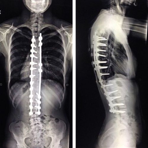 Рентген-снимок позвоночника с металлическими скобами