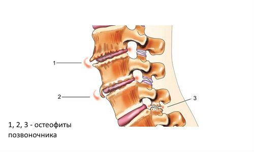 Остеофиты позвоночника