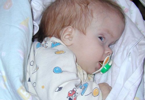 Младенец с гидроцефалией