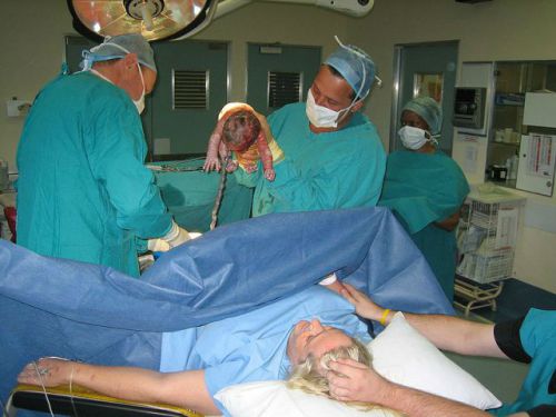 Кесарево сечение под спинальной анестезией