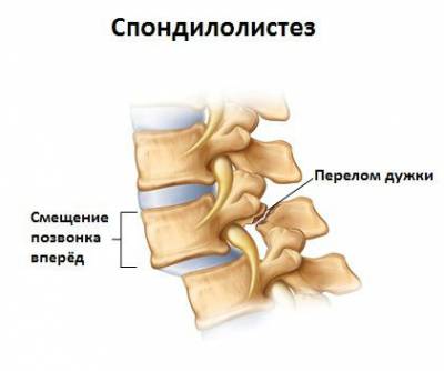 Смещение позвонка