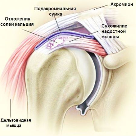 Синдром столкновения