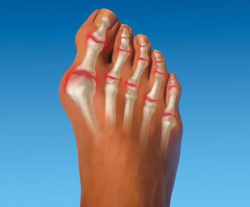 Деформация суставов на пальцах ноги