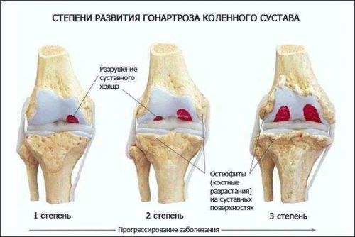 Развитие гонартроза