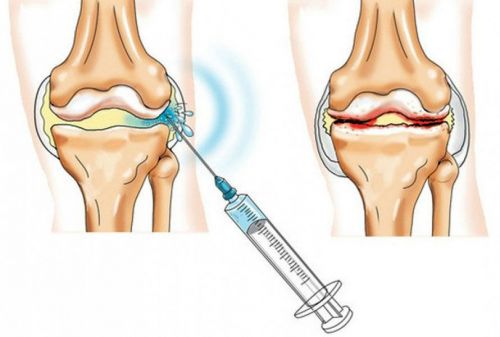 Внутрисуставная инъекция