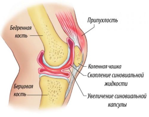 Синовит колена