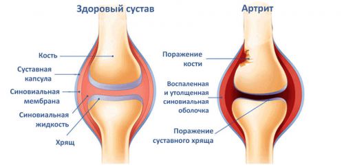 Поражения сустава при артрите